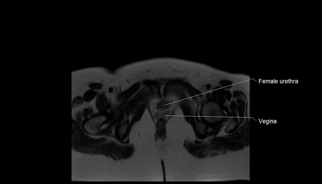 MRI fetal anatomy axial image 41.webp